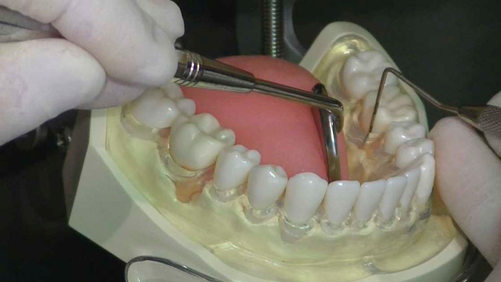 右下臼歯部舌側のプロービングの様子