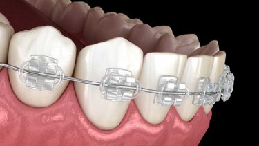 歯科矯正治療とう蝕予防の間に相関関係なし 豪州
