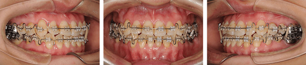 歯を整える装置の例