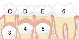 歯の交換（6、7、8番）