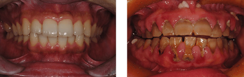 健全な口腔（左）と歯周病にかかっている口腔（右）