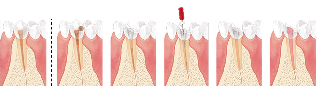 １．歯の神経をとる治療法