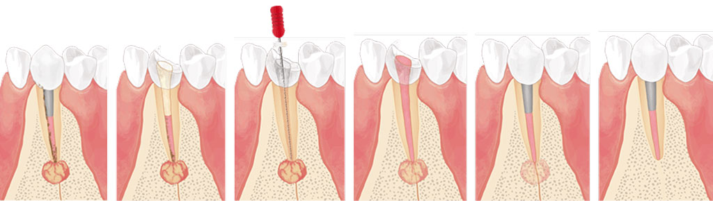 以前抜髄した歯が再度感染した場合の感染根管治療