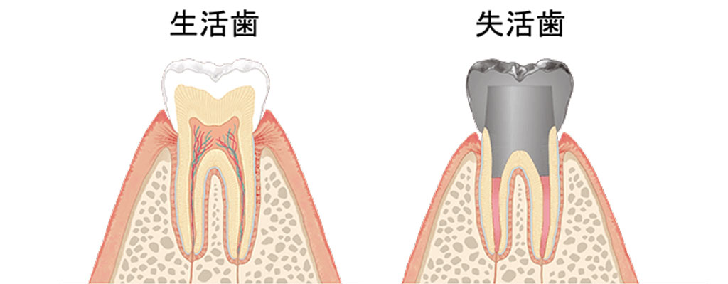 生活歯と失活歯