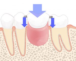 クラスプによって義歯を歯に固定し、レストを通じて、人工歯に垂直にかかる力を歯に負担させます。
