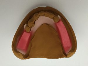 部分床義歯のバイト