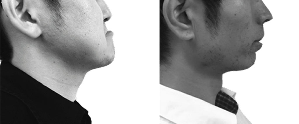 上顎と下顎の位置関係が大きく異なる患者さん