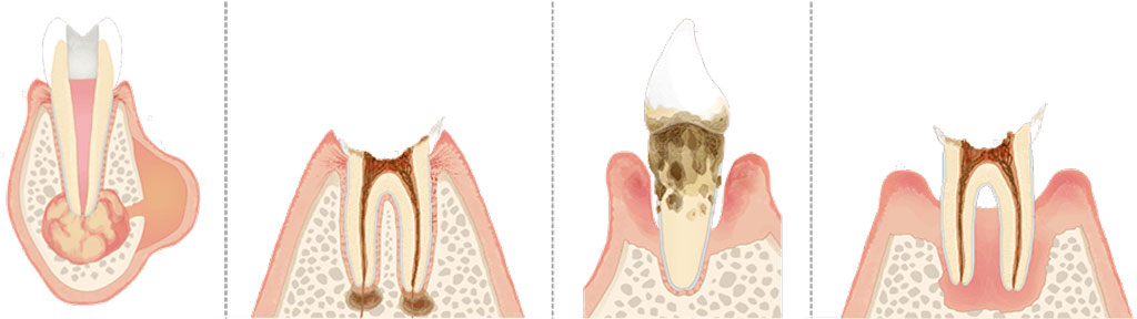 重度のう蝕や歯周病により、歯を残すことができない場合