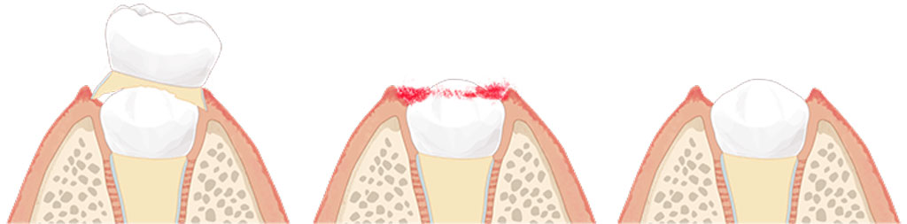 乳歯抜歯
