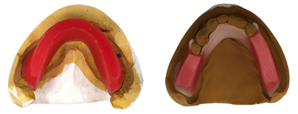 全部床義歯のバイト（左）　と　部分床義歯のバイト（右）