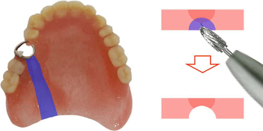 義歯の反対面を修理する