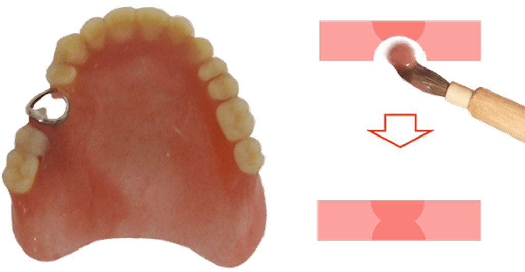 義歯の反対面を修理する