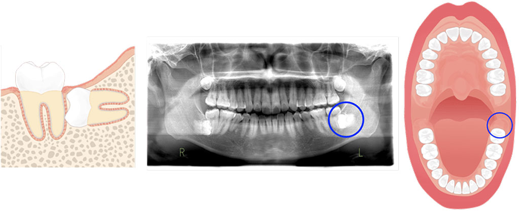 外科治療　STEP５　埋伏抜歯