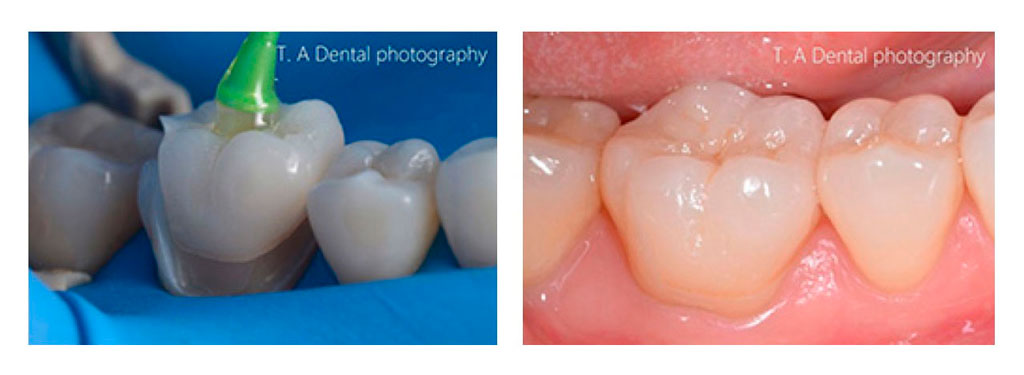 歯科医師が口の中で台の形をつくり型をとったものを歯科技工士が受け取り、歯を再現する