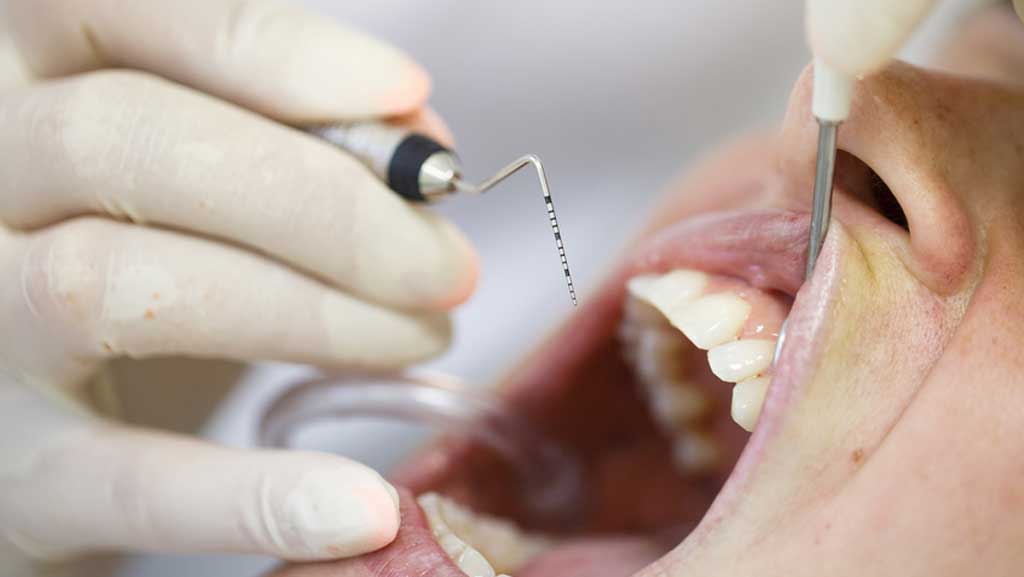 歯肉炎指数とプロービング値、BOP、プラーク付着量を計測