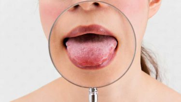 舌がんの特徴って？歯科衛生士がメインテナンス時に診るべきポイント