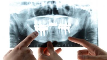 日本口腔インプラント学会認定歯科衛生士（インプラント専門歯科衛生士）ってどんな資格？