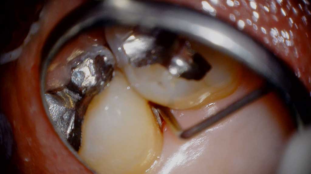 血液の吸引によって明示された歯肉縁下歯石