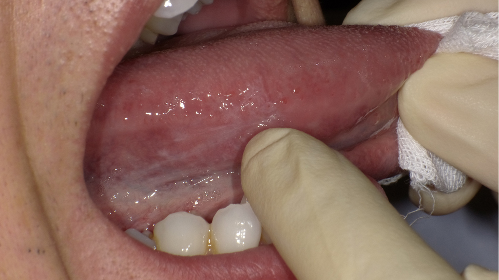 術前の舌の状態