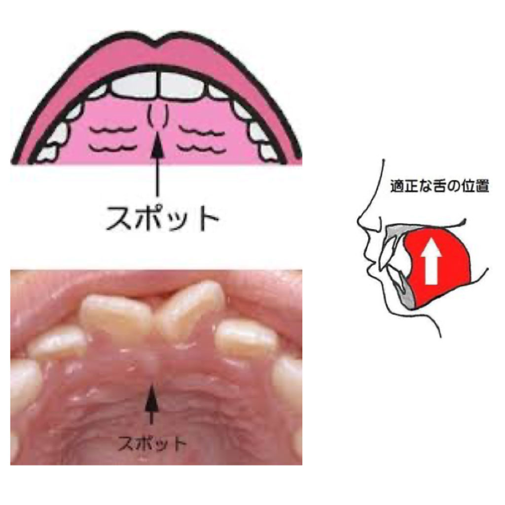 上顎口蓋部のスポット（外木徳子先生よりご提供）