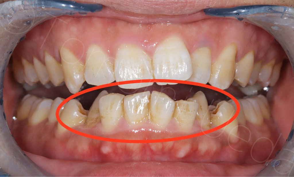 特徴的な前歯部唇側の着色