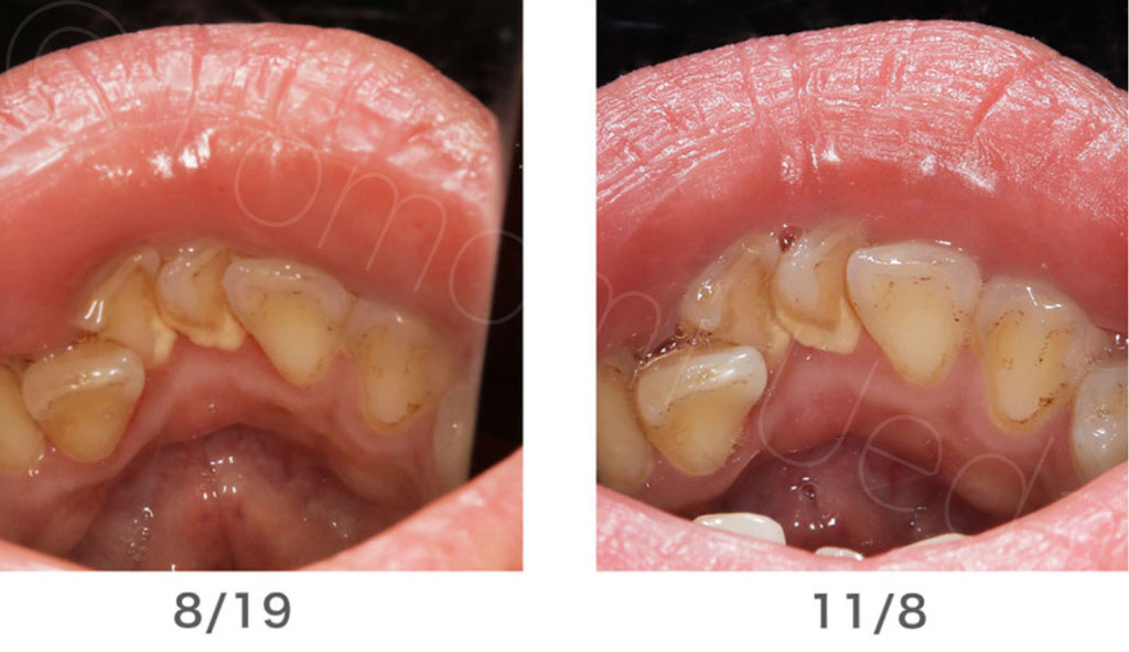除石から3ヶ月後（8/19）と、さらに3ヶ月経過後（11/8）を比較した写真