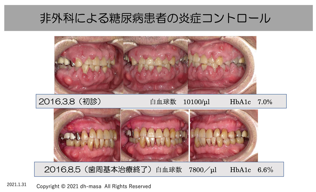 非外科の歯周病治療を行った糖尿病患者さんの口腔内写真の比較