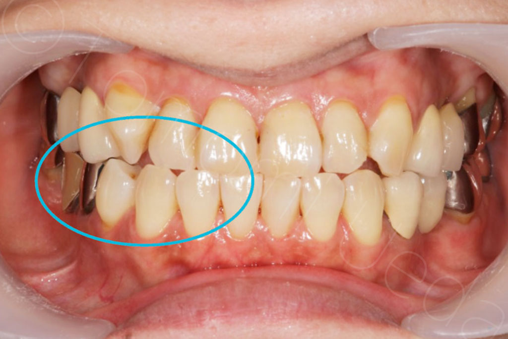 舌位の低下が歯石の付着を促すという仮説