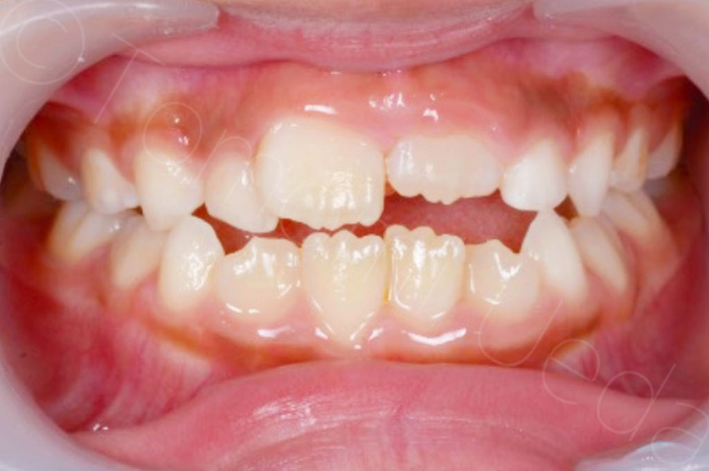 舌位の低下が歯石の付着を促すという仮説