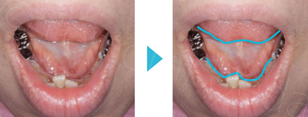 下顎歯と舌の形態が一致している写真