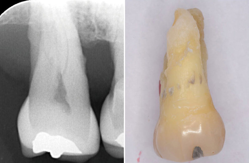 図１　歯周治療にて保存を試みたにもかかわらず抜歯にいたった上顎第二大臼歯