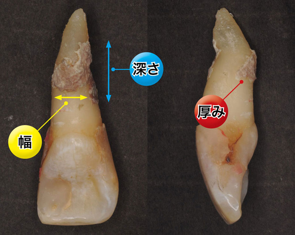 図５　縁下歯石の幅・深さ・厚みを探知する