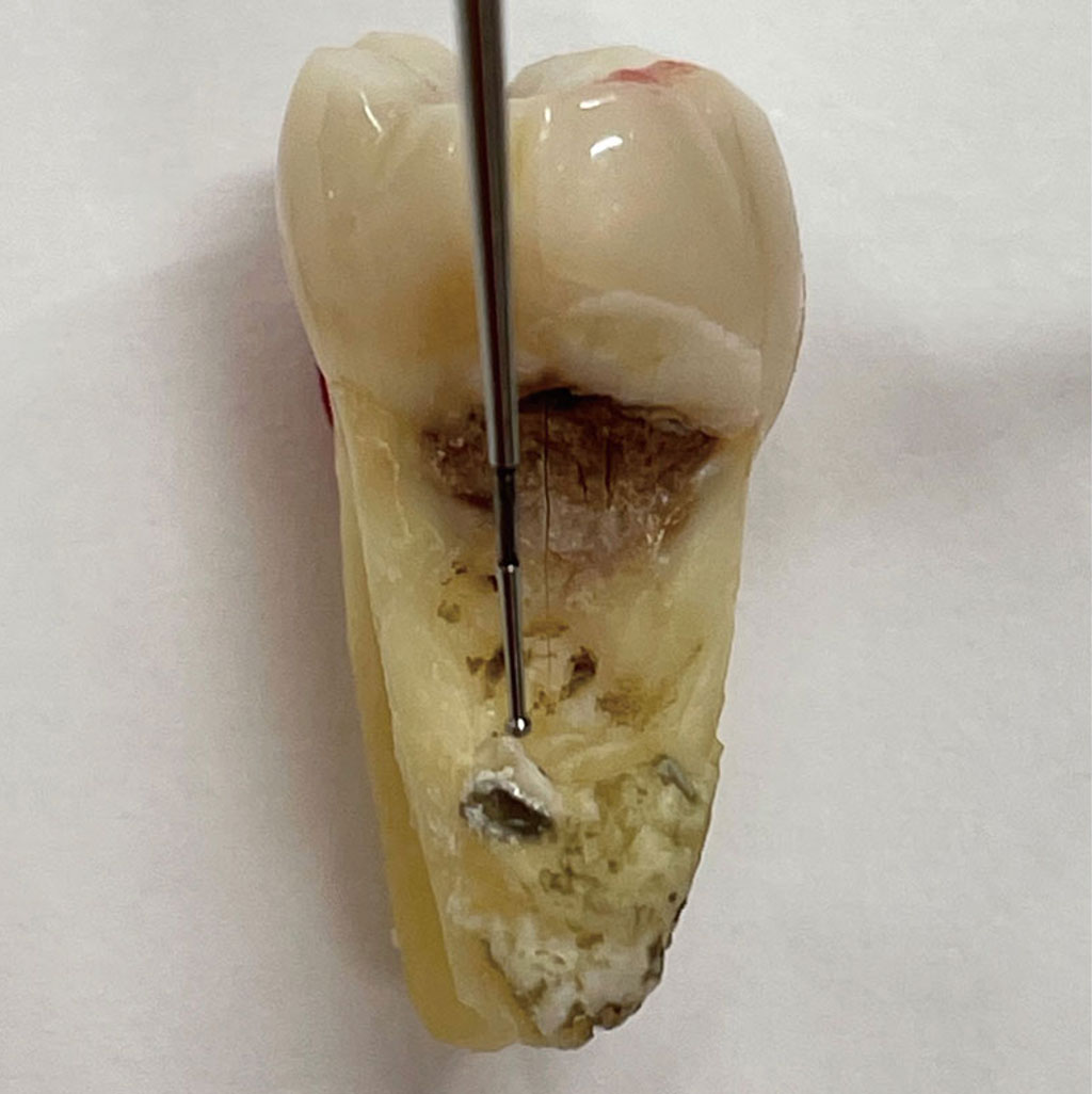 図６　セメント質の肥厚は、ザラザラゾーンに終点がなく、歯石よりも圧倒的に硬い感触があります