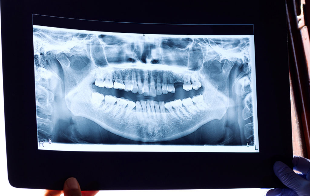 レントゲン写真から、う蝕や歯槽骨ライン、歯肉縁下歯石などが読み取れる