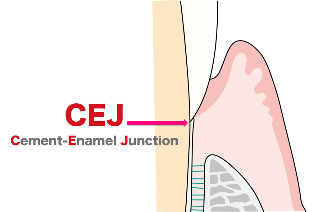 CEJ（Cement Enamel Junction）は健康な歯周組織であれば歯肉縁下に存在し、目視できない