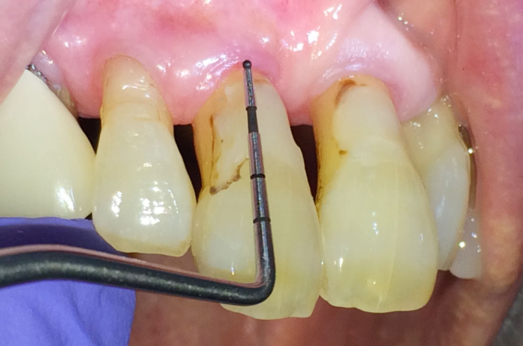 歯根露出した歯へのプロービング