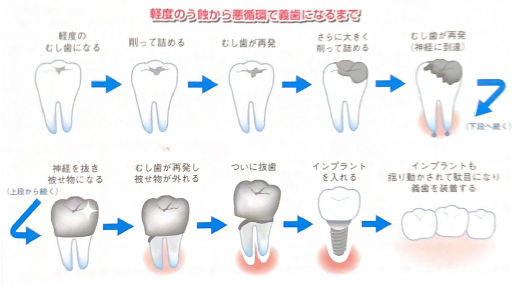 歯の経年変化がわかりやすいイラスト（提供：お口の取扱説明書―健康でいたければ、よく嚙むのをやめなさい，第一歯科出版，2022，**p．）