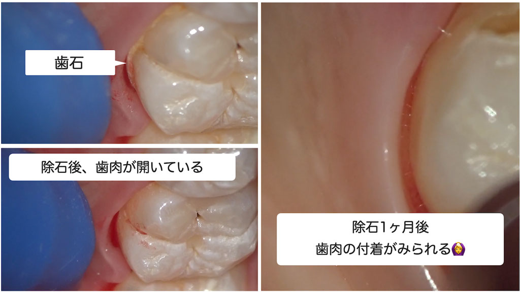 マイクロスコープで撮影した歯肉の改善の経過