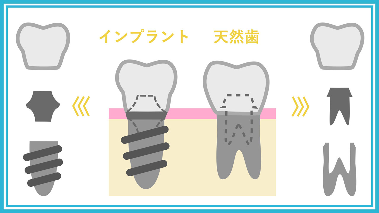 インプラントと天然歯の構造